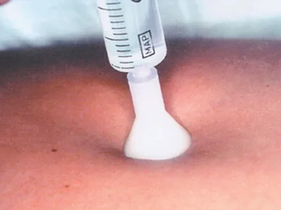 S.I.T. Skin Injection Therapy 31G 0,26X2.5 mm - alb