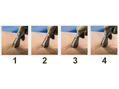 3M Precise skin stapler 15 staples - steril