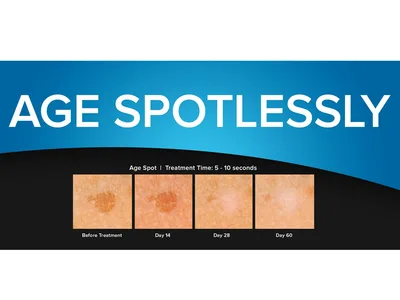 Dispozitiv criochirurgical CryoClear cu cartușă 16 g