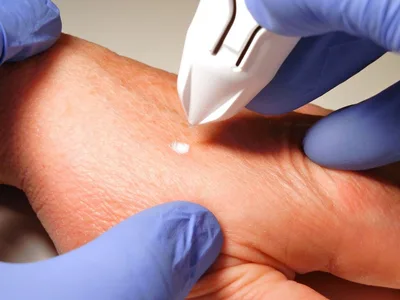 Dispozitiv criochirurgical CryoClear cu cartușă 16 g