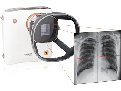 Cameră de radiografie portabilă REMEX KA6 cu colimator