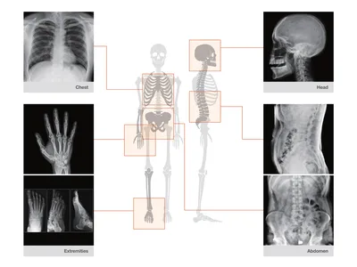 Cameră de radiografie portabilă REMEX KA6 cu colimator