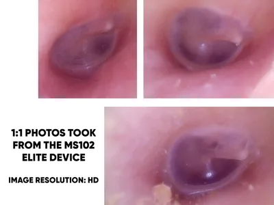 Otoscop video HD MD SCOPE MS102 - ELITE PACK