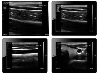 Viatom linear wireless portable ultrasound