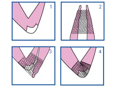 Plasă tubulară elastică Surgifix 3 pentru mână, cot și braț