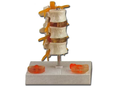 Model anatomic hernie de disc lombara, 3 vertebre