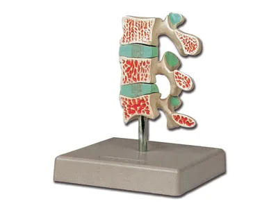 Model anatomic osteoporoza avansata, 3 vertebre