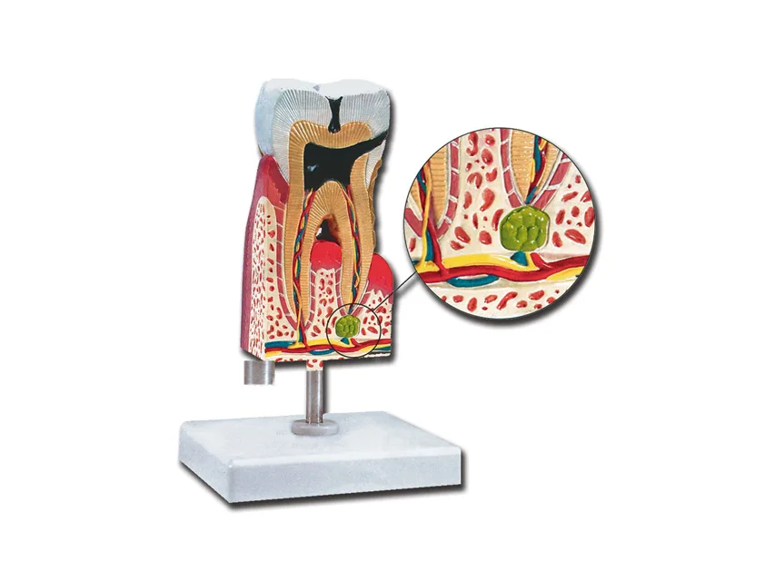 Molar inferior cu carie - 10X