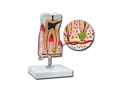 Model anatomia dintelui MOLAR inferior cu carie