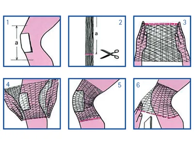 Plasă tubulară elastică E pentru picior, genunchi, picior - fără latex